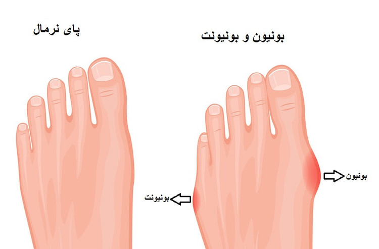 کفش طبی زنانه مخصوص استخوان هالوکس / کد 550